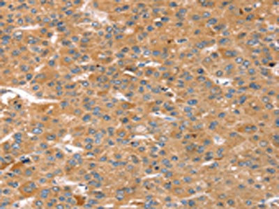 The image on the left is immunohistochemistry of paraffin-embedded Human liver cancer tissue using CSB-PA346002(CAPN7 Antibody) at dilution 1/20, on the right is treated with fusion protein. (Original magnification: x200) The image on the left is immunohistochemistry of paraffin-embedded Human liver cancer tissue using CSB-PA346002(CAPN7 Antibody) at dilution 1/20, on the right is treated with fusion protein. (Original magnification: x200)