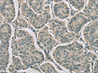 The image on the left is immunohistochemistry of paraffin-embedded Human breast cancer tissue using CSB-PA367981(RNASE3 Antibody) at dilution 1/20, on the right is treated with fusion protein. (Original magnification: x200)