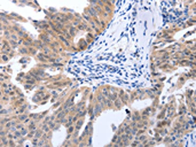 The image on the left is immunohistochemistry of paraffin-embedded Human ovarian cancer tissue using CSB-PA439945(MAP2K1 Antibody) at dilution 1/25, on the right is treated with synthetic peptide. (Original magnification: x200)