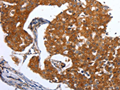 The image on the left is immunohistochemistry of paraffin-embedded Human breast cancer tissue using CSB-PA439945(MAP2K1 Antibody) at dilution 1/25, on the right is treated with synthetic peptide. (Original magnification: x200)