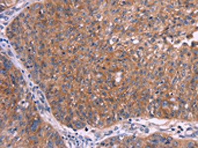 The image on the left is immunohistochemistry of paraffin-embedded Human ovarian cancer tissue using CSB-PA447792(EMP2 Antibody) at dilution 1/30, on the right is treated with synthetic peptide. (Original magnification: x200)