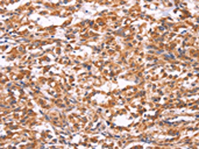 The image on the left is immunohistochemistry of paraffin-embedded Human thyroid cancer tissue using CSB-PA447792(EMP2 Antibody) at dilution 1/30, on the right is treated with synthetic peptide. (Original magnification: x200)