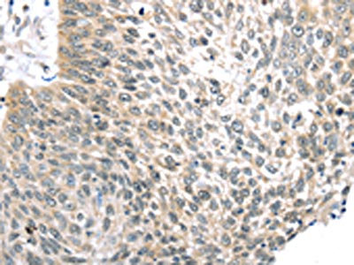 The image on the left is immunohistochemistry of paraffin-embedded Human lung cancer tissue using CSB-PA448902(TLK2 Antibody) at dilution 1/30, on the right is treated with fusion protein. (Original magnification: x200) The image on the left is immunohistochemistry of paraffin-embedded Human lung cancer tissue using CSB-PA448902(TLK2 Antibody) at dilution 1/30, on the right is treated with fusion protein. (Original magnification: x200)