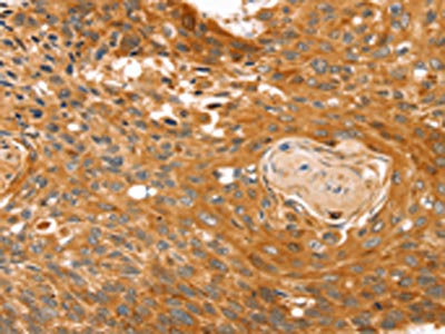 The image on the left is immunohistochemistry of paraffin-embedded Human esophagus cancer tissue using CSB-PA449923(RGS4 Antibody) at dilution 1/25, on the right is treated with fusion protein. (Original magnification: x200)