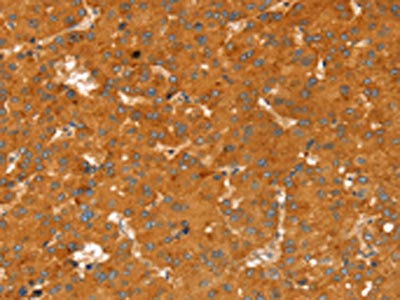 The image on the left is immunohistochemistry of paraffin-embedded Human liver cancer tissue using CSB-PA449923(RGS4 Antibody) at dilution 1/25, on the right is treated with fusion protein. (Original magnification: x200)