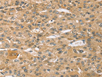 The image on the left is immunohistochemistry of paraffin-embedded Human liver cancer tissue using CSB-PA546167(SPON1 Antibody) at dilution 1/30, on the right is treated with synthetic peptide. (Original magnification: x200)