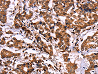 The image on the left is immunohistochemistry of paraffin-embedded Human breast cancer tissue using CSB-PA555338(CARD11 Antibody) at dilution 1/40, on the right is treated with fusion protein. (Original magnification: x200)