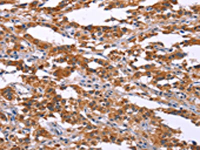 The image on the left is immunohistochemistry of paraffin-embedded Human thyroid cancer tissue using CSB-PA557996(MAP3K2 Antibody) at dilution 1/15, on the right is treated with synthetic peptide. (Original magnification: x200)