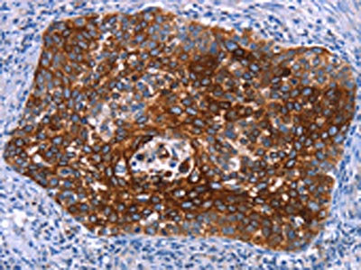 The image on the left is immunohistochemistry of paraffin-embedded Human cervical cancer tissue using CSB-PA557996(MAP3K2 Antibody) at dilution 1/15, on the right is treated with synthetic peptide. (Original magnification: x200)