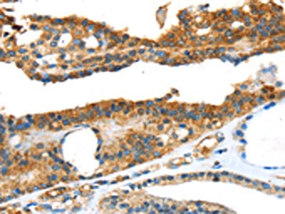 The image on the left is immunohistochemistry of paraffin-embedded Human thyroid cancer tissue using CSB-PA558561(SNAI3 Antibody) at dilution 1/20, on the right is treated with fusion protein. (Original magnification: x200) The image on the left is immunohistochemistry of paraffin-embedded Human thyroid cancer tissue using CSB-PA558561(SNAI3 Antibody) at dilution 1/20, on the right is treated with fusion protein. (Original magnification: x200)