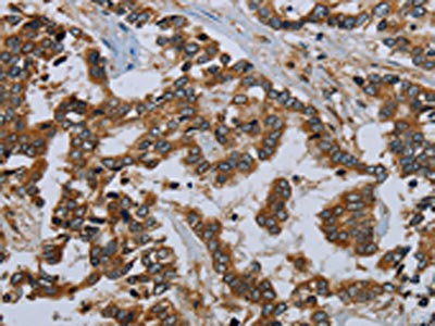 The image on the left is immunohistochemistry of paraffin-embedded Human liver cancer tissue using CSB-PA560273(MIER2 Antibody) at dilution 1/50, on the right is treated with fusion protein. (Original magnification: x200)
