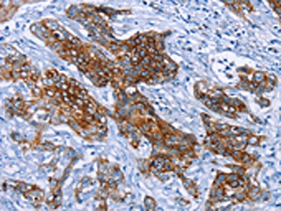 The image on the left is immunohistochemistry of paraffin-embedded Human cervical cancer tissue using CSB-PA560275(PMPCB Antibody) at dilution 1/25, on the right is treated with fusion protein. (Original magnification: x200)