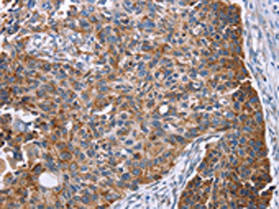 The image on the left is immunohistochemistry of paraffin-embedded Human esophagus cancer tissue using CSB-PA560275(PMPCB Antibody) at dilution 1/25, on the right is treated with fusion protein. (Original magnification: x200) The image on the left is immunohistochemistry of paraffin-embedded Human esophagus cancer tissue using CSB-PA560275(PMPCB Antibody) at dilution 1/25, on the right is treated with fusion protein. (Original magnification: x200)