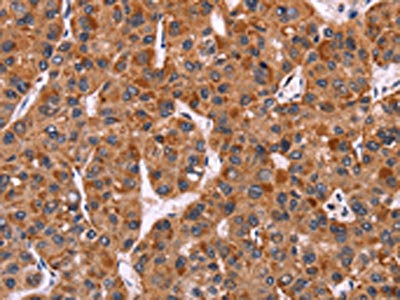 The image on the left is immunohistochemistry of paraffin-embedded Human liver cancer tissue using CSB-PA567327(CARD11 Antibody) at dilution 1/40, on the right is treated with fusion protein. (Original magnification: x200)