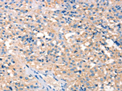 The image on the left is immunohistochemistry of paraffin-embedded Human thyroid cancer tissue using CSB-PA568434(PRPS1/2/1L1 Antibody) at dilution 1/30, on the right is treated with synthetic peptide. (Original magnification: x200)