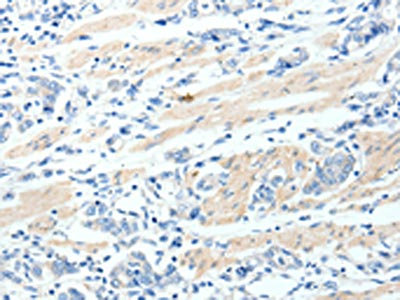 The image on the left is immunohistochemistry of paraffin-embedded Human gastric cancer tissue using CSB-PA570132(MAP4K1 Antibody) at dilution 1/30, on the right is treated with synthetic peptide. (Original magnification: x200)