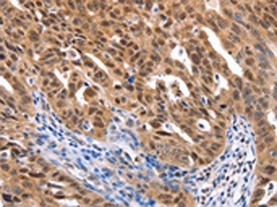 The image on the left is immunohistochemistry of paraffin-embedded Human ovarian cancer tissue using CSB-PA570222(MAP2K1 Antibody) at dilution 1/25, on the right is treated with synthetic peptide. (Original magnification: x200)