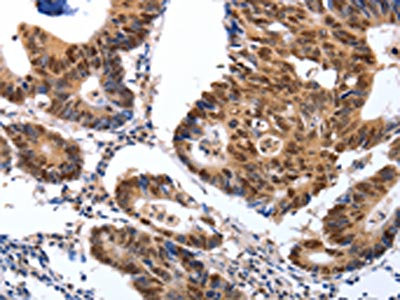 The image on the left is immunohistochemistry of paraffin-embedded Human colon cancer tissue using CSB-PA570222(MAP2K1 Antibody) at dilution 1/25, on the right is treated with synthetic peptide. (Original magnification: x200)