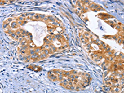 The image on the left is immunohistochemistry of paraffin-embedded Human cervical cancer tissue using CSB-PA579873(MUSK Antibody) at dilution 1/30, on the right is treated with fusion protein. (Original magnification: x200)