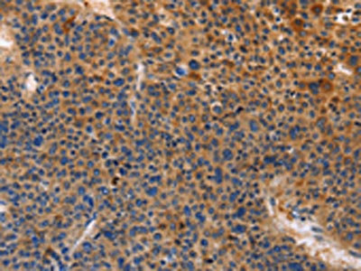 The image on the left is immunohistochemistry of paraffin-embedded Human liver cancer tissue using CSB-PA579873(MUSK Antibody) at dilution 1/30, on the right is treated with fusion protein. (Original magnification: x200)