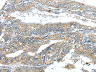 The image on the left is immunohistochemistry of paraffin-embedded Human esophagus cancer tissue using CSB-PA583502(LPAR1 Antibody) at dilution 1/20, on the right is treated with synthetic peptide. (Original magnification: x200)