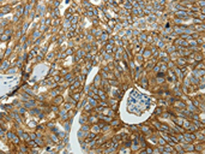 The image on the left is immunohistochemistry of paraffin-embedded Human ovarian cancer tissue using CSB-PA587029(SLC16A1 Antibody) at dilution 1/50, on the right is treated with synthetic peptide. (Original magnification: x200)