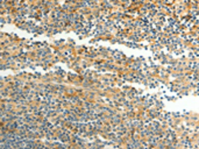 The image on the left is immunohistochemistry of paraffin-embedded Human tonsil tissue using CSB-PA589025(CFHR1 Antibody) at dilution 1/40, on the right is treated with fusion protein. (Original magnification: x200)