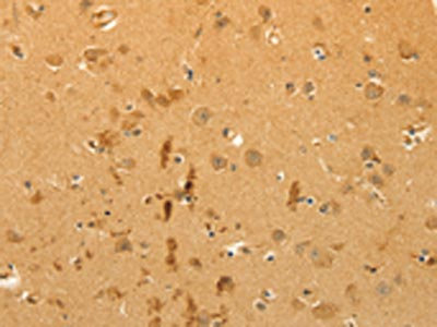 The image on the left is immunohistochemistry of paraffin-embedded Human brain tissue using CSB-PA589025(CFHR1 Antibody) at dilution 1/40, on the right is treated with fusion protein. (Original magnification: x200) The image on the left is immunohistochemistry of paraffin-embedded Human brain tissue using CSB-PA589025(CFHR1 Antibody) at dilution 1/40, on the right is treated with fusion protein. (Original magnification: x200)