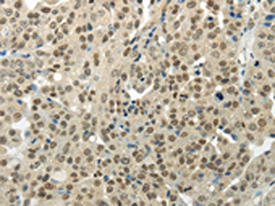 The image on the left is immunohistochemistry of paraffin-embedded Human breast cancer tissue using CSB-PA591538(BAZ1B Antibody) at dilution 1/35, on the right is treated with synthetic peptide. (Original magnification: x200) The image on the left is immunohistochemistry of paraffin-embedded Human breast cancer tissue using CSB-PA591538(BAZ1B Antibody) at dilution 1/35, on the right is treated with synthetic peptide. (Original magnification: x200)