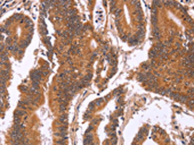 The image on the left is immunohistochemistry of paraffin-embedded Human colon cancer tissue using CSB-PA591907(CDC37L1 Antibody) at dilution 1/60, on the right is treated with fusion protein. (Original magnification: x200)