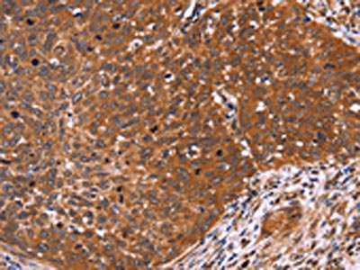 The image on the left is immunohistochemistry of paraffin-embedded Human cervical cancer tissue using CSB-PA591907(CDC37L1 Antibody) at dilution 1/60, on the right is treated with fusion protein. (Original magnification: x200)