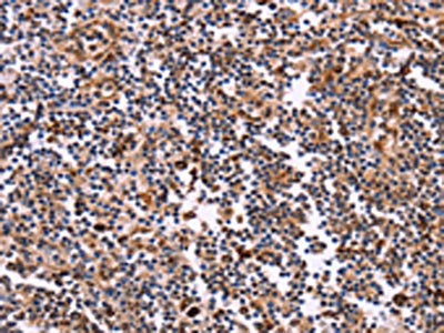 The image on the left is immunohistochemistry of paraffin-embedded Human tonsil tissue using CSB-PA593413(CLUAP1 Antibody) at dilution 1/50, on the right is treated with fusion protein. (Original magnification: x200)