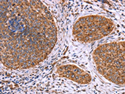 The image on the left is immunohistochemistry of paraffin-embedded Human cervical cancer tissue using CSB-PA593413(CLUAP1 Antibody) at dilution 1/50, on the right is treated with fusion protein. (Original magnification: x200)