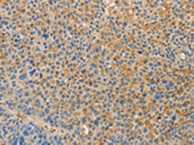 The image on the left is immunohistochemistry of paraffin-embedded Human liver cancer tissue using CSB-PA594088(VTCN1 Antibody) at dilution 1/30, on the right is treated with fusion protein. (Original magnification: x200)