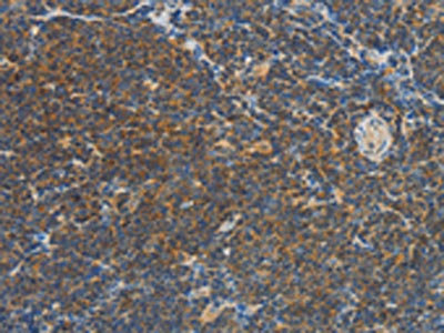 The image on the left is immunohistochemistry of paraffin-embedded Human Lymphoma tissue using CSB-PA594088(VTCN1 Antibody) at dilution 1/30, on the right is treated with fusion protein. (Original magnification: x200) The image on the left is immunohistochemistry of paraffin-embedded Human Lymphoma tissue using CSB-PA594088(VTCN1 Antibody) at dilution 1/30, on the right is treated with fusion protein. (Original magnification: x200)