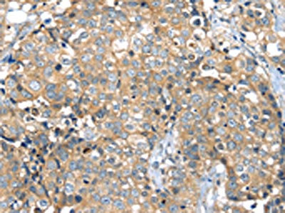 The image on the left is immunohistochemistry of paraffin-embedded Human breast cancer tissue using CSB-PA594626(MAGEA11 Antibody) at dilution 1/35, on the right is treated with synthetic peptide. (Original magnification: x200)