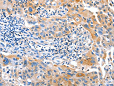 The image on the left is immunohistochemistry of paraffin-embedded Human breast cancer tissue using CSB-PA598310(IMMT Antibody) at dilution 1/12, on the right is treated with fusion protein. (Original magnification: x200)