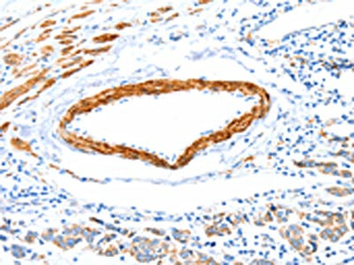 The image on the left is immunohistochemistry of paraffin-embedded Human colon cancer tissue using CSB-PA598310(IMMT Antibody) at dilution 1/12, on the right is treated with fusion protein. (Original magnification: x200)