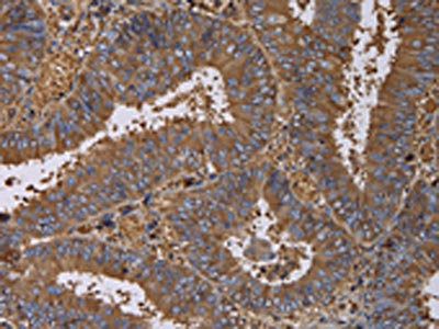 The image on the left is immunohistochemistry of paraffin-embedded Human colon cancer tissue using CSB-PA607012(FADS1 Antibody) at dilution 1/60, on the right is treated with fusion protein. (Original magnification: x200)