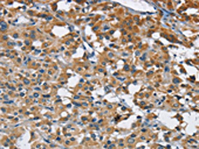 The image on the left is immunohistochemistry of paraffin-embedded Human thyroid cancer tissue using CSB-PA614837(ANKHD1 Antibody) at dilution 1/40, on the right is treated with fusion protein. (Original magnification: x200)