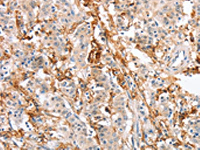 The image on the left is immunohistochemistry of paraffin-embedded Human gastric cancer tissue using CSB-PA617106(SIGLEC9 Antibody) at dilution 1/30, on the right is treated with fusion protein. (Original magnification: x200)