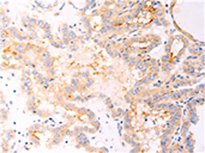 The image on the left is immunohistochemistry of paraffin-embedded Human thyroid cancer tissue using CSB-PA617153(RELA Antibody) at dilution 1/25, on the right is treated with fusion protein. (Original magnification: x200) The image on the left is immunohistochemistry of paraffin-embedded Human thyroid cancer tissue using CSB-PA617153(RELA Antibody) at dilution 1/25, on the right is treated with fusion protein. (Original magnification: x200)