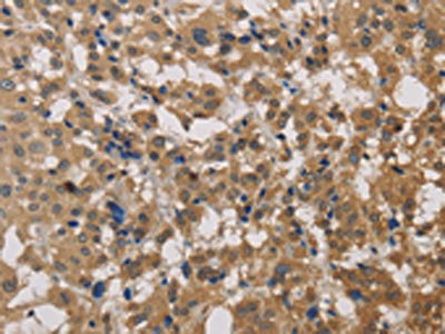 The image on the left is immunohistochemistry of paraffin-embedded Human thyroid cancer tissue using CSB-PA617990(DEGS1 Antibody) at dilution 1/40, on the right is treated with fusion protein. (Original magnification: x200)
