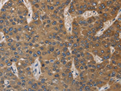 The image on the left is immunohistochemistry of paraffin-embedded Human liver cancer tissue using CSB-PA617990(DEGS1 Antibody) at dilution 1/40, on the right is treated with fusion protein. (Original magnification: x200)