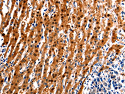 The image on the left is immunohistochemistry of paraffin-embedded Human liver cancer tissue using CSB-PA620355(ID4 Antibody) at dilution 1/20, on the right is treated with synthetic peptide. (Original magnification: x200)