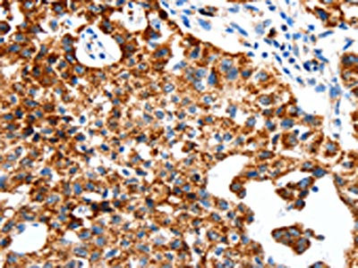 The image on the left is immunohistochemistry of paraffin-embedded Human lung cancer tissue using CSB-PA630217(SLC2A1 Antibody) at dilution 1/50, on the right is treated with synthetic peptide. (Original magnification: x200) The image on the left is immunohistochemistry of paraffin-embedded Human lung cancer tissue using CSB-PA630217(SLC2A1 Antibody) at dilution 1/50, on the right is treated with synthetic peptide. (Original magnification: x200)