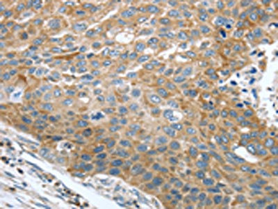 The image on the left is immunohistochemistry of paraffin-embedded Human esophagus cancer tissue using CSB-PA634052(TRAK1 Antibody) at dilution 1/25, on the right is treated with fusion protein. (Original magnification: x200)