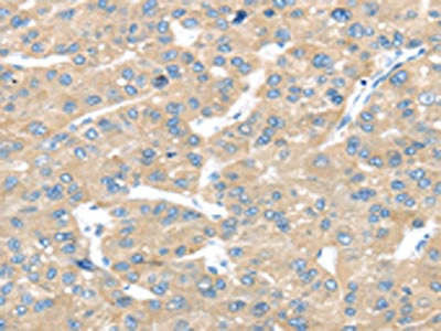 The image on the left is immunohistochemistry of paraffin-embedded Human liver cancer tissue using CSB-PA634052(TRAK1 Antibody) at dilution 1/25, on the right is treated with fusion protein. (Original magnification: x200)
