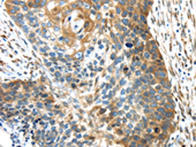 The image on the left is immunohistochemistry of paraffin-embedded Human esophagus cancer tissue using CSB-PA639635(TMED4 Antibody) at dilution 1/45, on the right is treated with fusion protein. (Original magnification: x200)