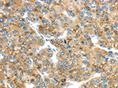 The image on the left is immunohistochemistry of paraffin-embedded Human liver cancer tissue using CSB-PA639635(TMED4 Antibody) at dilution 1/45, on the right is treated with fusion protein. (Original magnification: x200)